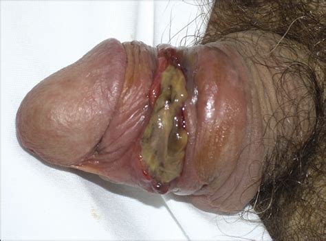 Introduction to telehealth and paediatrics online course: Mucous Membrane Ulcers in an Immunocompromised Patient ...