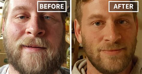Before And After Pictures Of Recovering Alcoholics Picturemeta