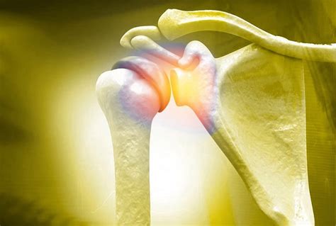 What Happens If A Torn Rotator Cuff Goes Untreated