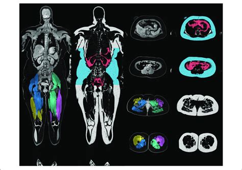 Illustration Of Body Composition Merged And Calibrated Water Fat Mri