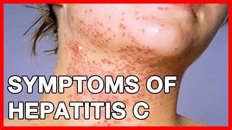 What Is Hepatitis C Is It A Std Transmission Vaccine And Symptoms
