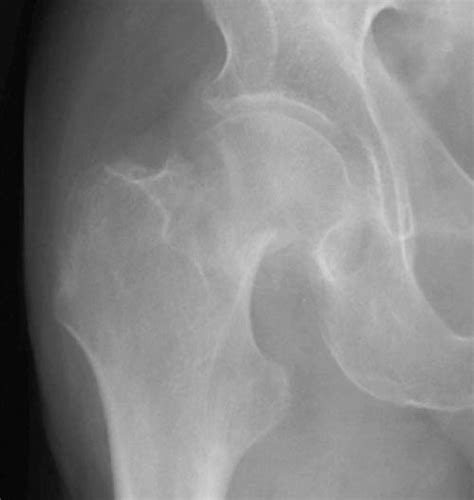 Femoral Neck Fractures - Trauma - Orthobullets