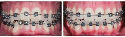 Ortodont Bucuresti Clinica Ortodontie Preturi And Tratamente Gentle