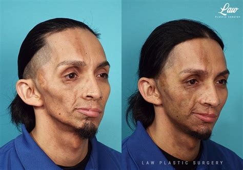 parry romberg syndrome before and after photos law plastic surgery