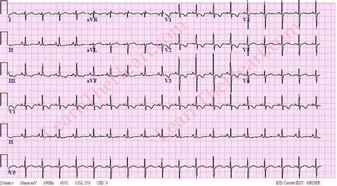 Right Ventricular Hypertrophy With Strain Rvh Ecg Example