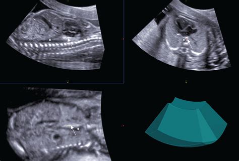 Sonographic Demonstration Of Fetal Esophagus Using Three‐dimensional