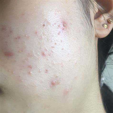 Skin Concern Closed Comedones Red Inflamed Bumps And Pie R