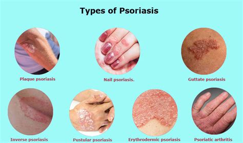 Psoriasis Symptoms Treatment And Preventions Of Flare Ups
