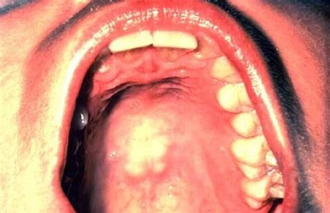 Itchy Roof Of Mouth Causes Treatment Remedies Beautyhealthplus