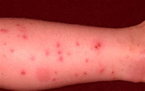 Flea Bites On Humans Symptoms Treatment Pictures Hubpages
