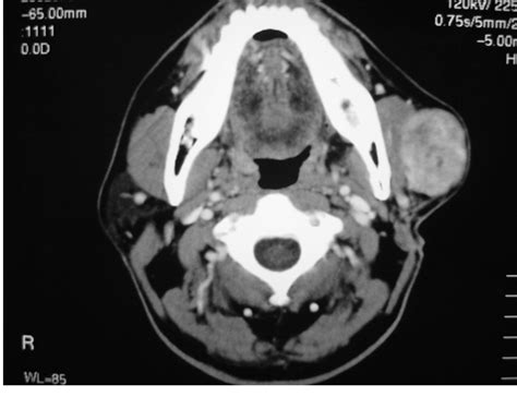 Figure 1 From A Case Report Of Metastasizing Myoepithelial Carcinoma Of