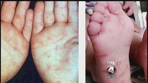 hand foot and mouth disease spreading youtube