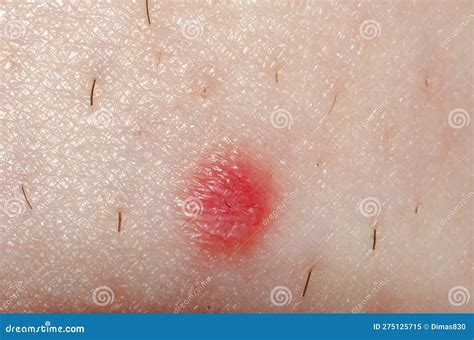 Nevus Or Mole On The Human Body Close Up Skin Cancer Keratosis Or