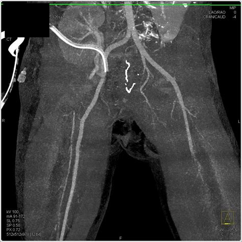 Diastase Of The Symphysis Pubis In Patter With Bladder