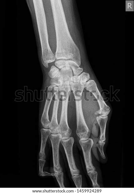 Wrist X Ray Anatomy Radiology Radiographic Stock Photo 1459924289