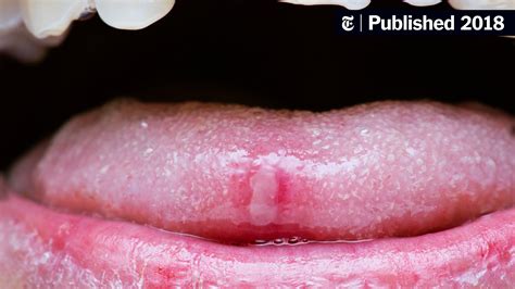 What Causes Canker Sores The New York Times