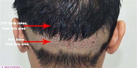 Things To Know About FUT FUE BHT Hair Transplant Technique