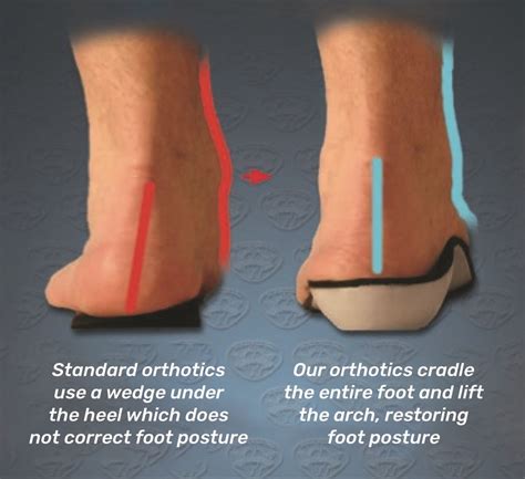 Arthritis Pain Custom Orthotic Foot And Arch Supportive Insoles Can Help