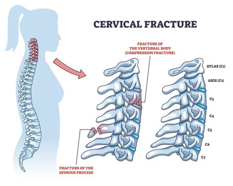 Cervical Fracture Broken Neck Types Symptoms Causes And Treatment