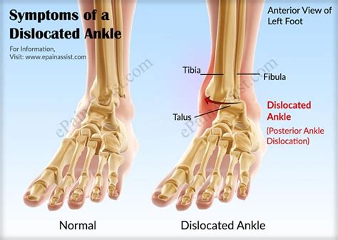Dislocated Ankletreatmentrecoveryprognosiscausessymptoms