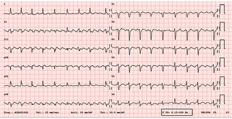 Ecg Showing Typical Atrial Flutter With Ventricular Rate At About
