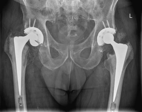 A Radiograph Of A Distal Femur Fracture After A Ground Level Fall