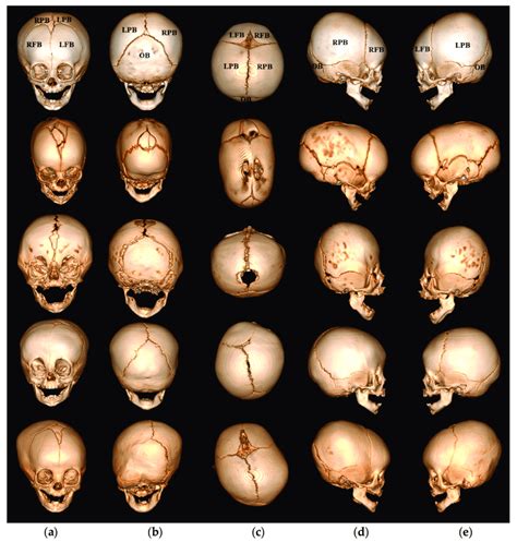 Volume Rendering Images Of Normal Skull First Row And Skulls Of Four