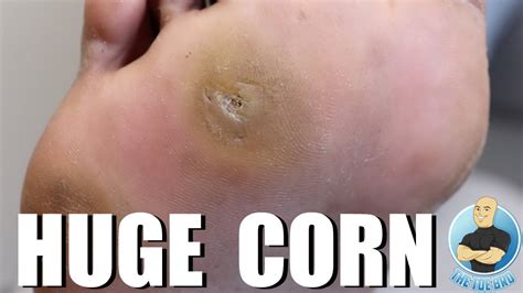 Huge Foot Corn Removal Treatment Youtube