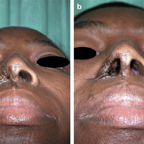 A Preoperative Complete Nostril Stenosis B Nine Months Post