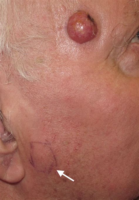 These are located close to the. Clinical Photos of Merkel Cell Carcinoma | Merkel Cell ...