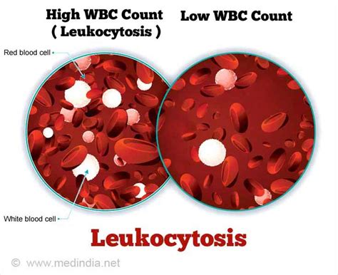 Leukocytosis Causes Symptoms Diagnosis Treatment