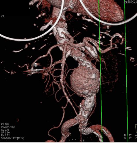 Abdominal Aortic Aneurysm With Vascular Mapping Shows Extensive