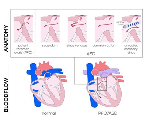 Atrial Septal Defects Atrial Septal Defect Congenital Heart Defect