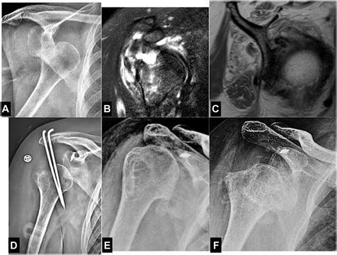 Neglected And Locked Anterior Shoulder Dislocation Functional Outcomes