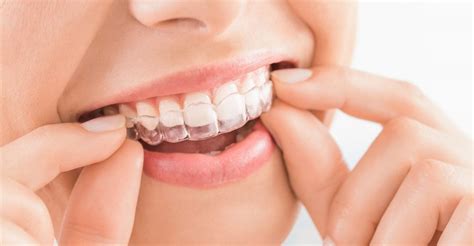 What Are The Advantages And Disadvantages Of Aligners