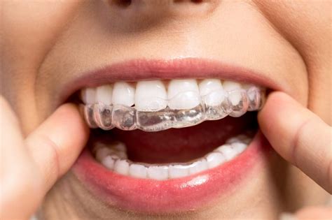Tips For Cleaning Your Invisalign Aligners Bracify 3d Orthodontics