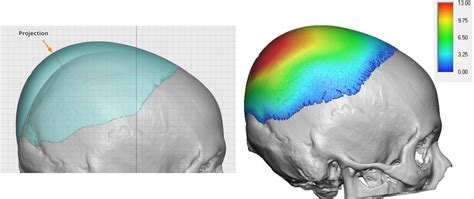 Custom Skull Implant Projection For Female Criown Augmentation Side