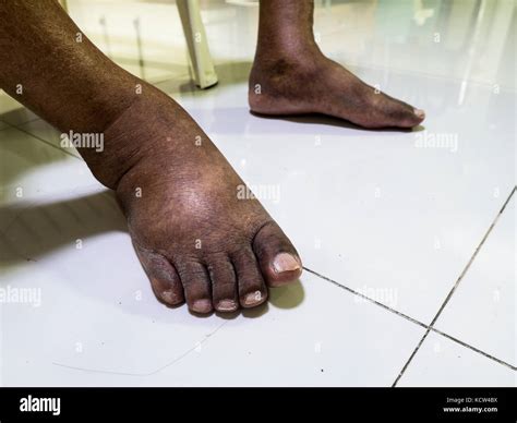 The Feet Of People With Diabetes Dull And Swollen Due To The Toxicity