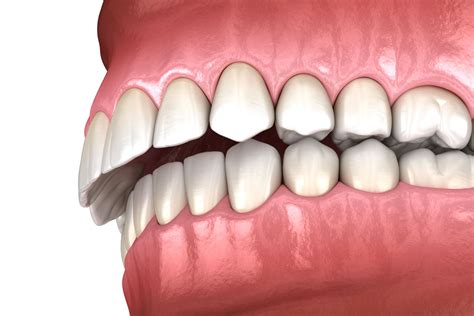Braces Before And After Overbite Causes Symptoms Treatments Social