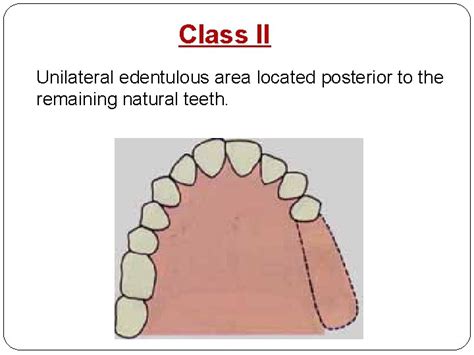 Classification Of Partially Edentulous Arches Requirements Of An