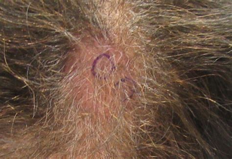Discoid Lupus Erythematosus When A Superficial Injury Is A Red Herring