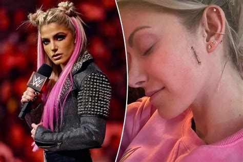 Wwes Alexa Bliss Posts Photo Of Stitches From Skin Cancer Surgery