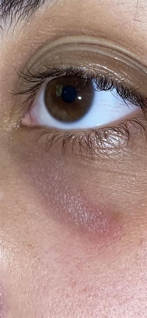 Skin Concern My Under Eye Is So Dry What Do I Do About It More