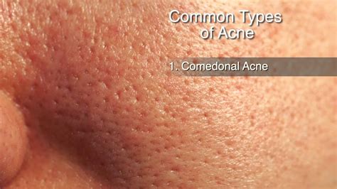 How To Treat Different Types Of Acne Youtube