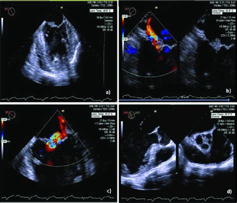 A Mitral Valve With Slight Thickening Of The Leaflets And An Echogenic