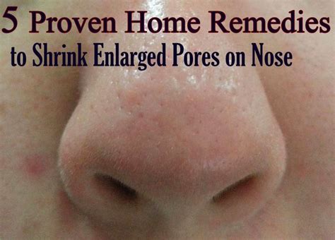 5 Proven Home Remedies To Shrink Enlarged Pores On Nose Nose Pores