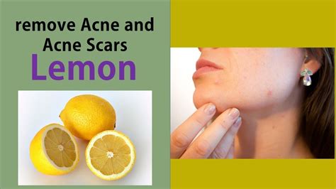 Does Lemon Juice Help Acne Examples And Forms