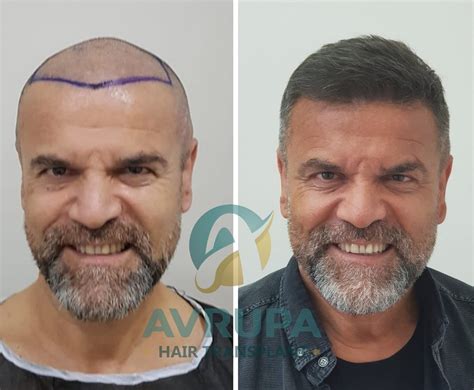 FUE Hair Transplant Results 10 Real Cases With Photos Clinic Advisor