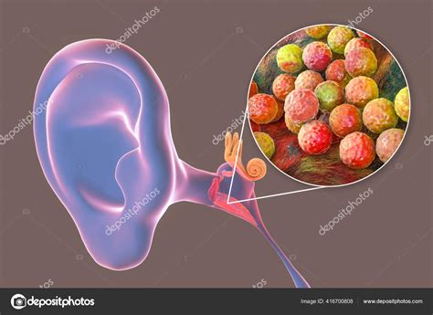 Otitis Media Caused Bacteria Staphylococcus Aureus Inflammatory Disease