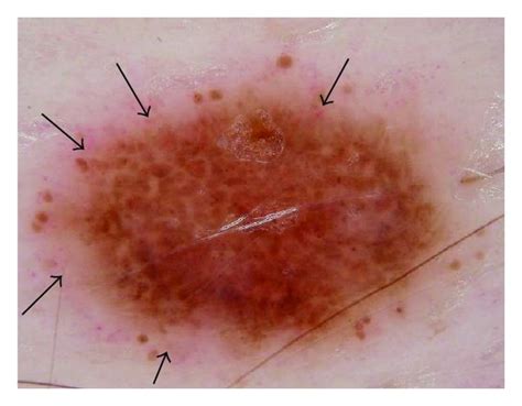 A In Situ Melanoma Arising Within A Congenital Lesion 4 Mm Abdomen